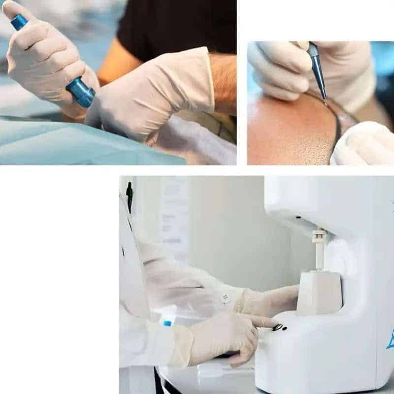 Combined Sapphire FUE and DHI hair transplant treatment at Mercure Istanbul