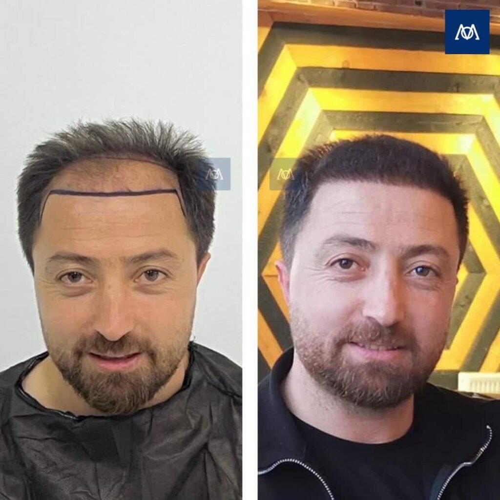 Hair transplant result for extensive hair loss at Mercure Istanbul
