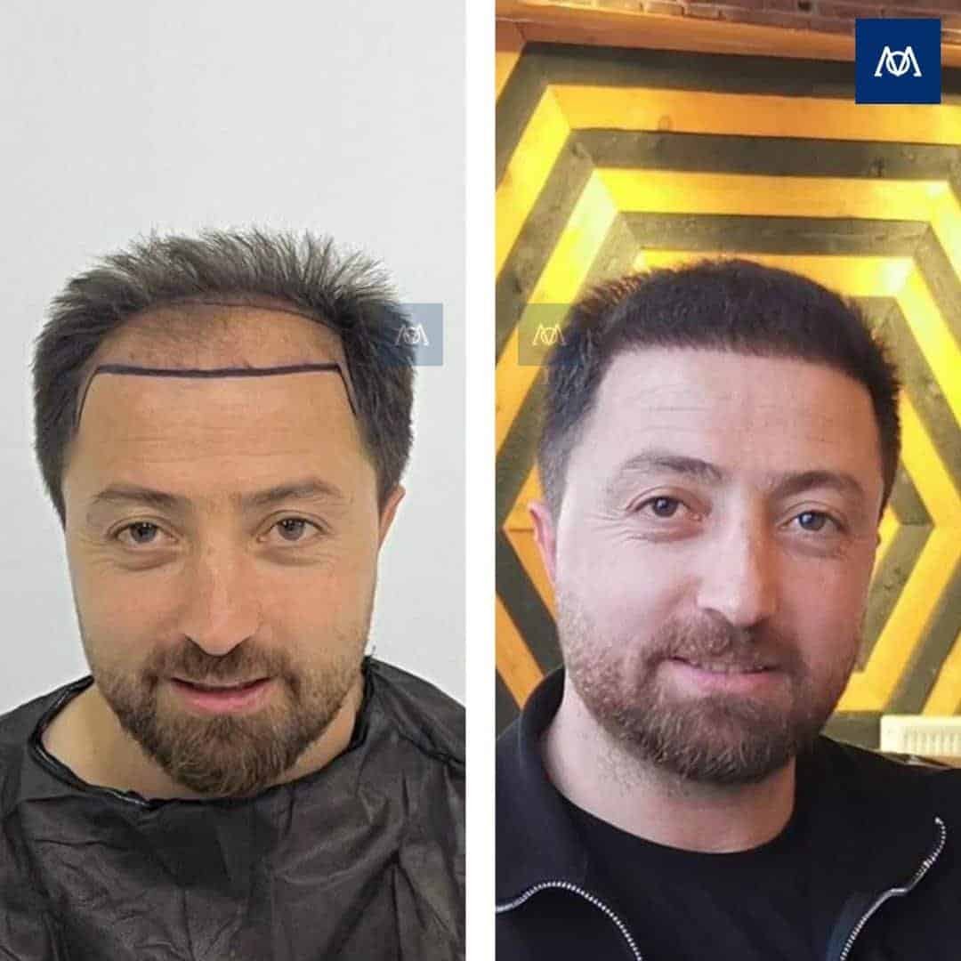 Resultaat van een haartransplantatie bij uitgebreid haarverlies bij Mercure Istanbul