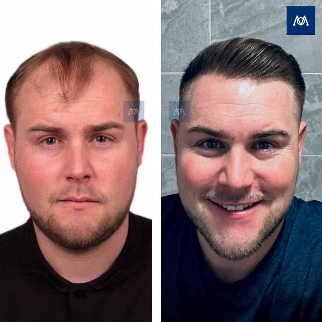 Resultaat van een haartransplantatie van het voorhoofd en de middenscalp bij Mercure Istanbul