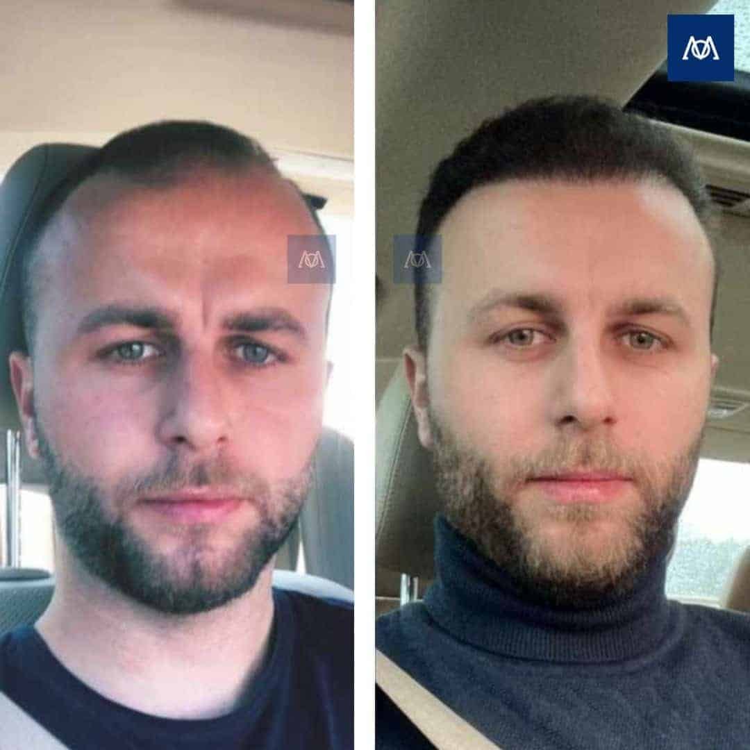 Resultaat van een haartransplantatie van de haarlijn en het voorhoofd bij Mercure Istanbul
